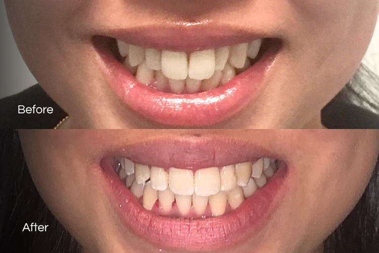 braces1