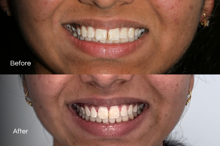 braces2