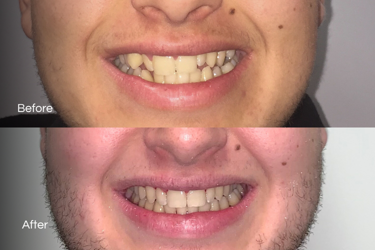 braces3