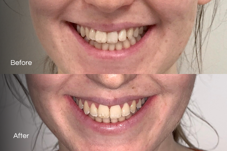 braces7