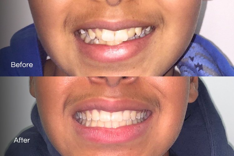 braces8