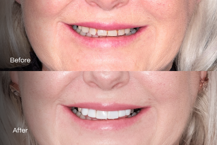 veneers