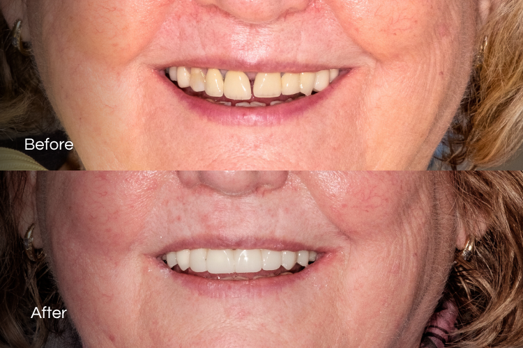 veneers17