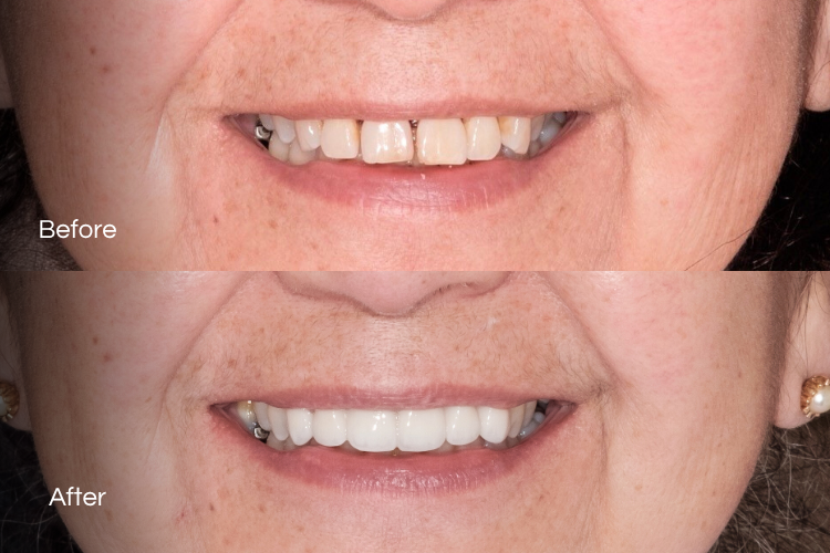 veneers18