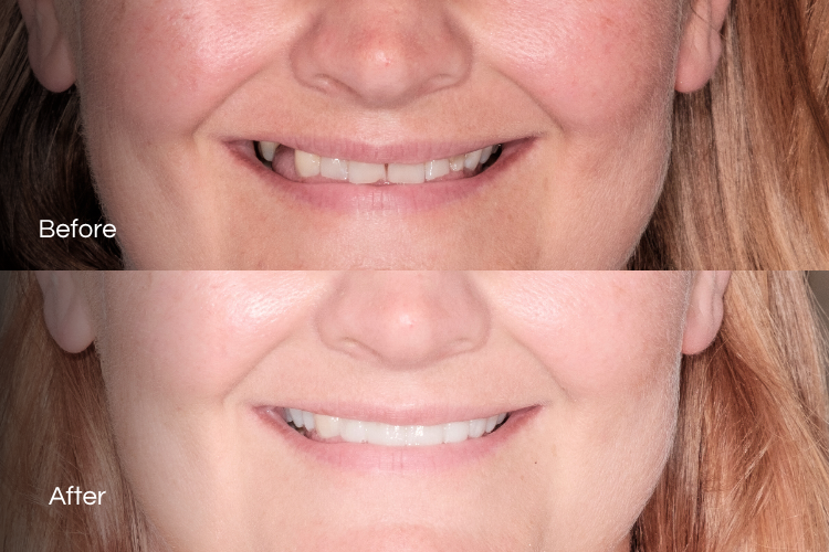 veneers