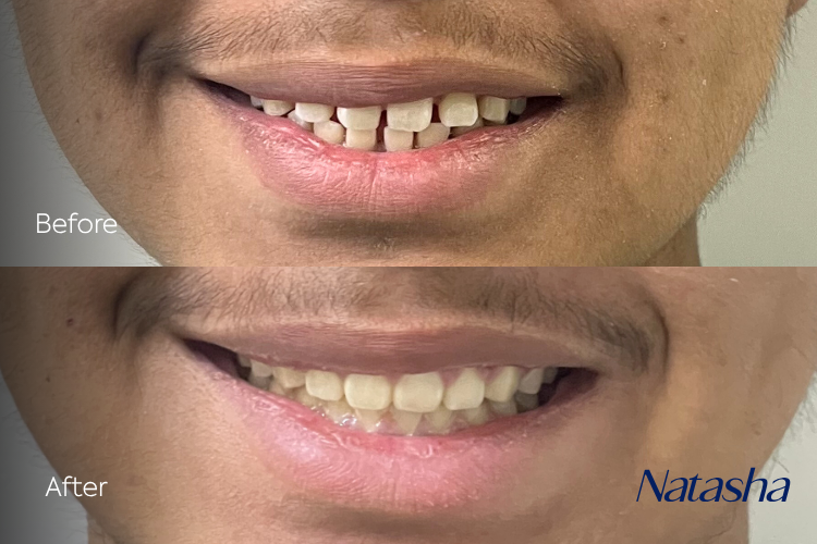 braces23