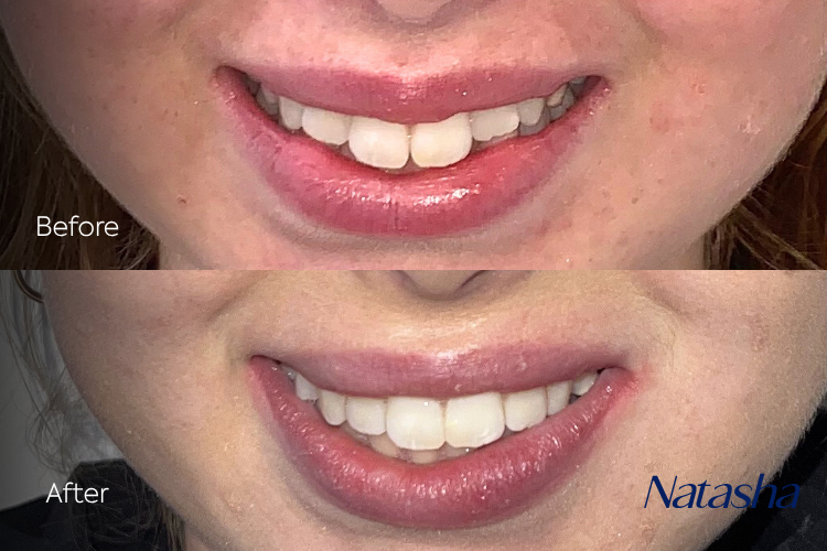 braces24