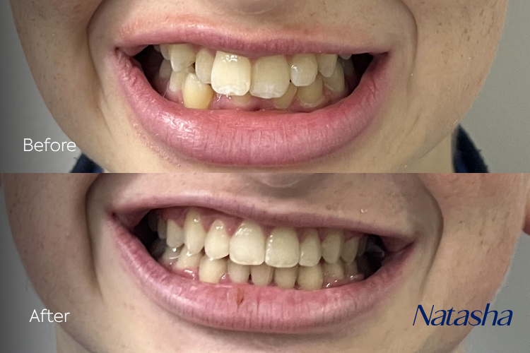 braces25