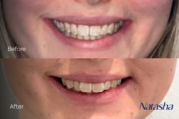 invisalign1