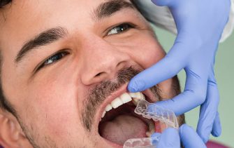 orthodontics spark aligners